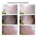 Lápiz Láser Para Acné, Disminución De Arrugas y Cicatrices Suaves - Lunaurea | Skincare, Maquillaje, Cosméticos