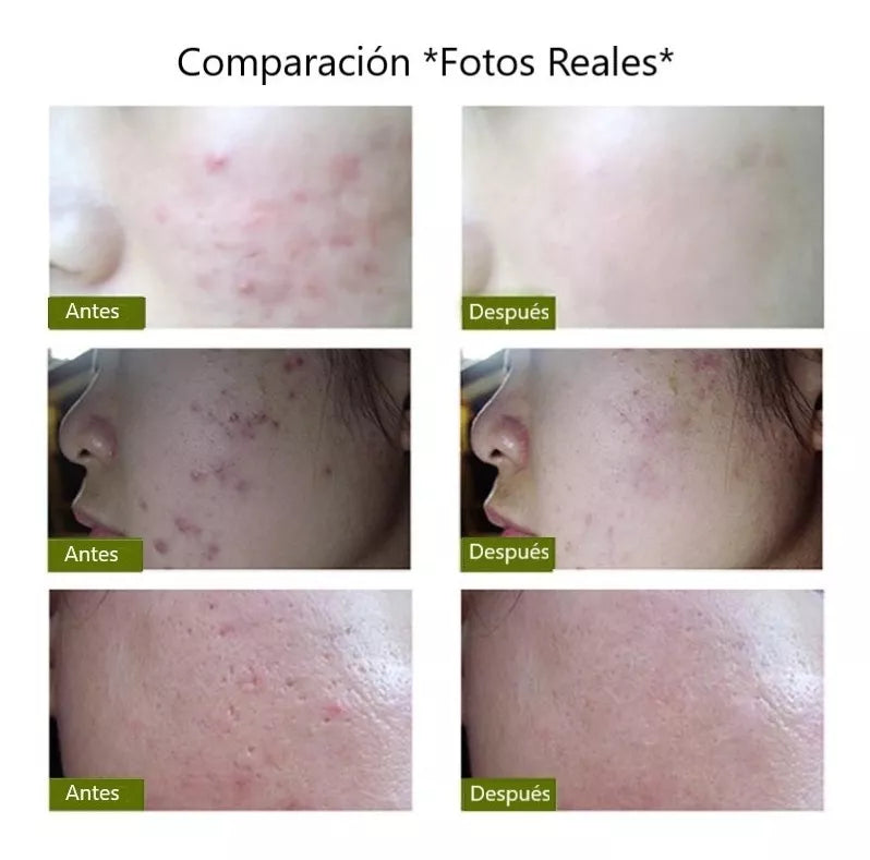 Lápiz Láser Para Acné, Disminución De Arrugas y Cicatrices Suaves