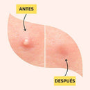 Parches/Stickers Hidrocoloides para Espinillas, Granos y Acné - Lunaurea | Skincare, Maquillaje, Cosméticos