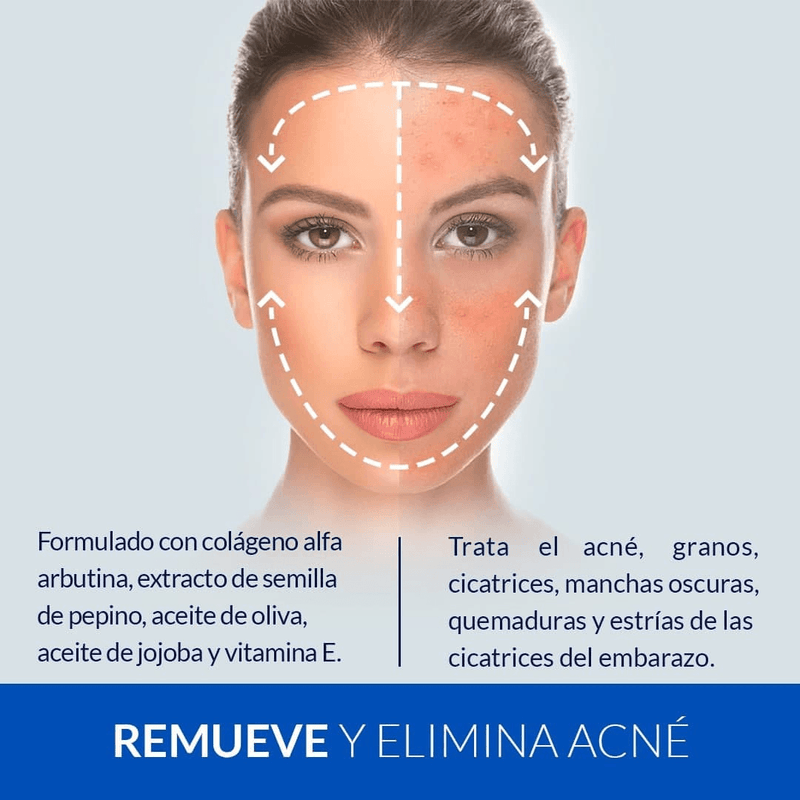 Tónico Anti-Acné - Afrodita - Lunaurea | Skincare, Maquillaje, Cosméticos